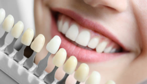 How to choose the color of your dental veneers?
