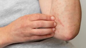 How to treat a skin allergy?