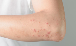 Symptoms of skin allergy